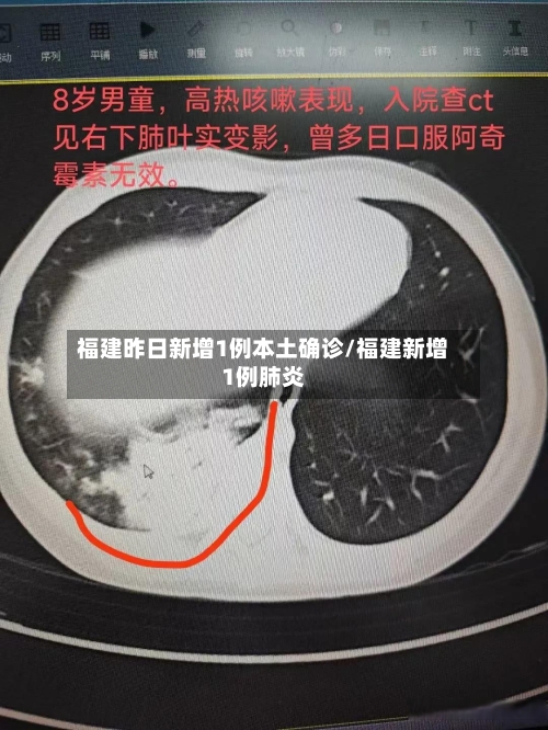 福建昨日新增1例本土确诊/福建新增1例肺炎-第2张图片